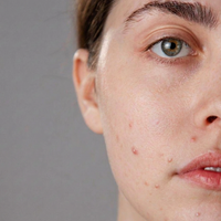 Acne Prone Skin - Skin Wellness